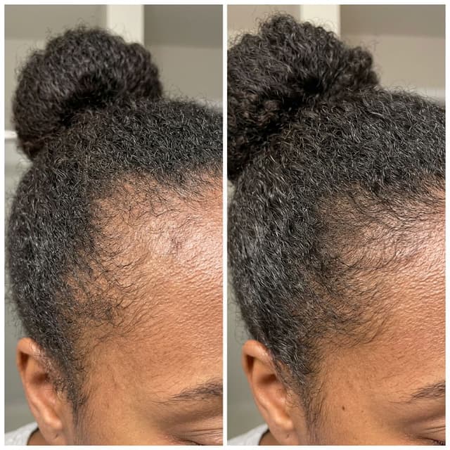 Bomi tester-submitted hairline comparison