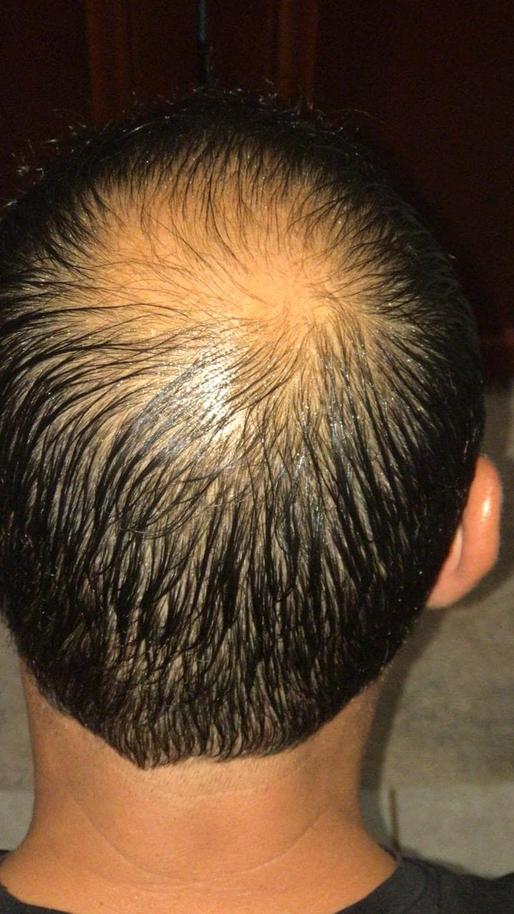 After - 2 weeks of consistent use