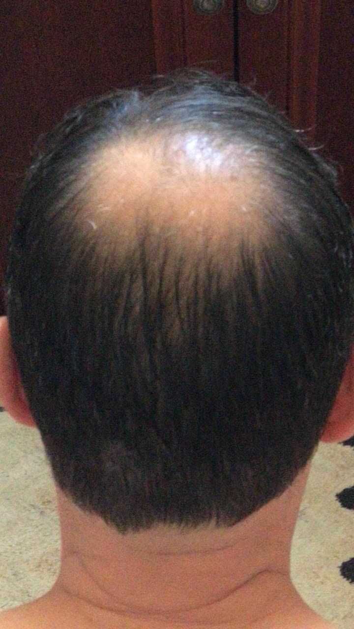 Before - 2 weeks of consistent use