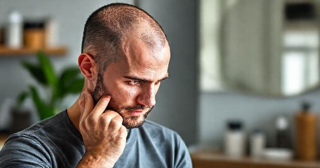 Close-up of a man's scalp showing hair loss patterns